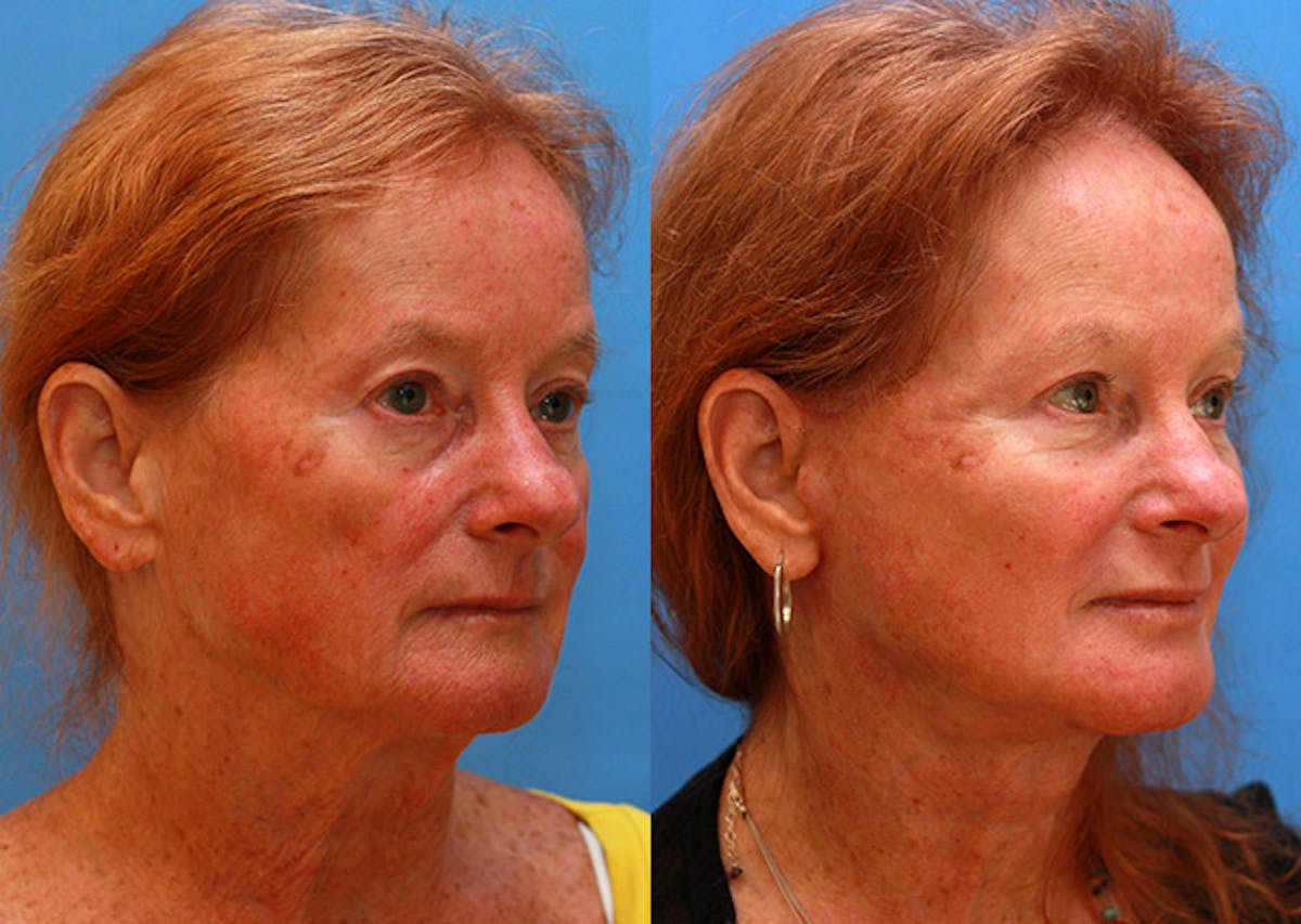 Neck Before & After Gallery - Patient 111467 - Image 2