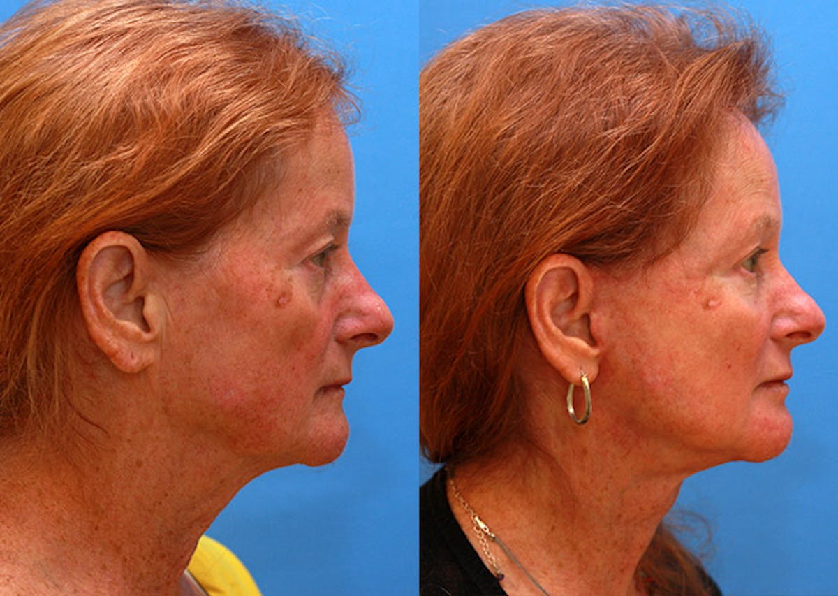 Neck Before & After Gallery - Patient 111467 - Image 3