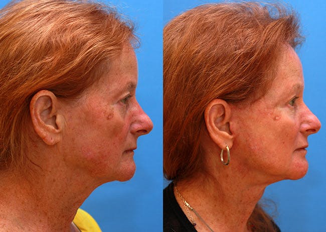 Neck Lift Before & After Gallery - Patient 388753 - Image 3