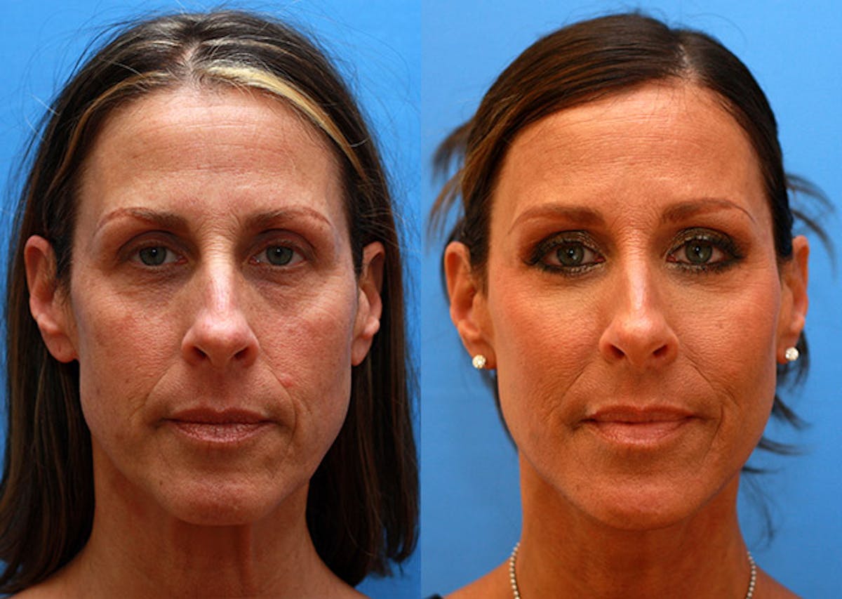 Neck Before & After Gallery - Patient 184797 - Image 1