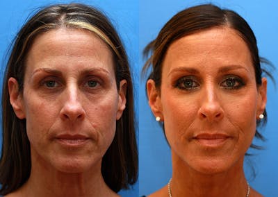Neck Before & After Gallery - Patient 184797 - Image 1
