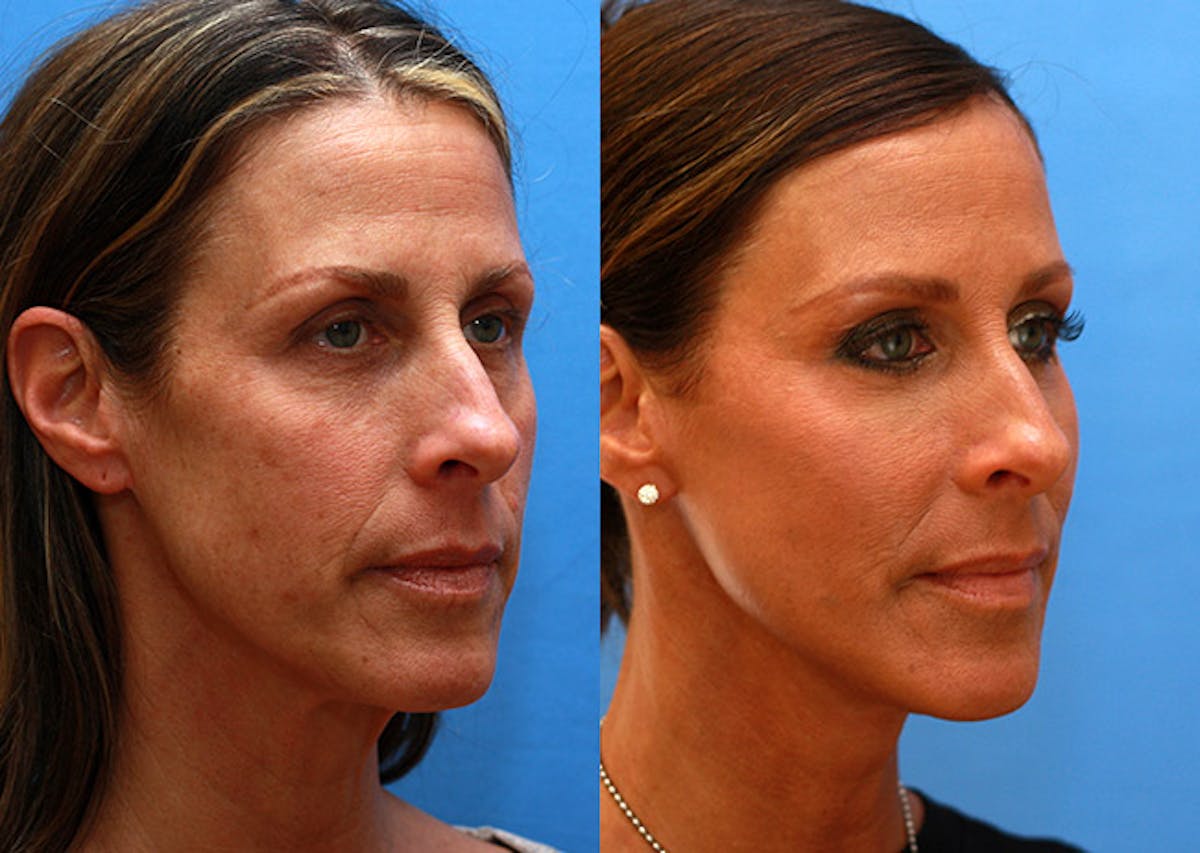 Neck Before & After Gallery - Patient 184797 - Image 2