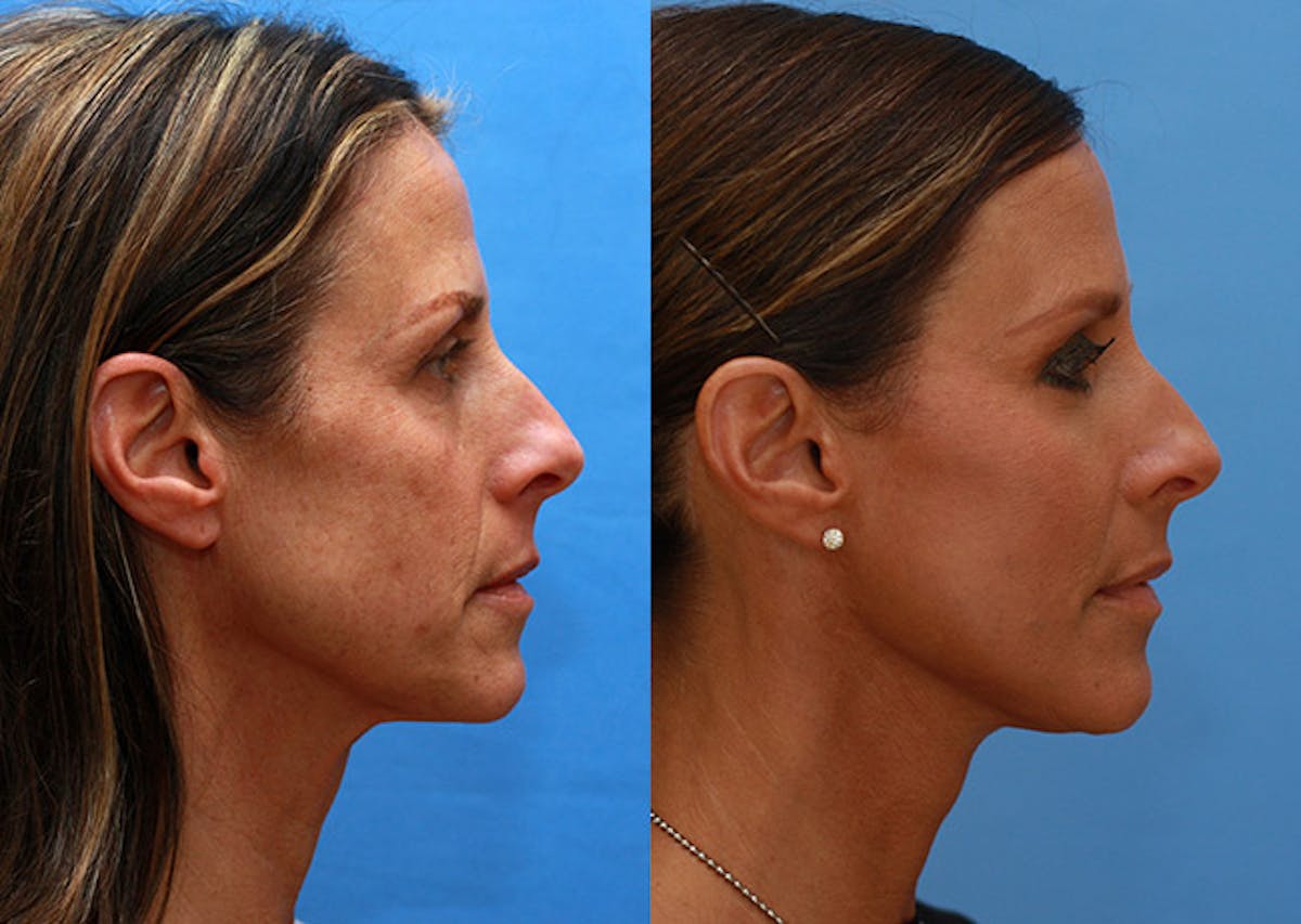 Neck Before & After Gallery - Patient 184797 - Image 3