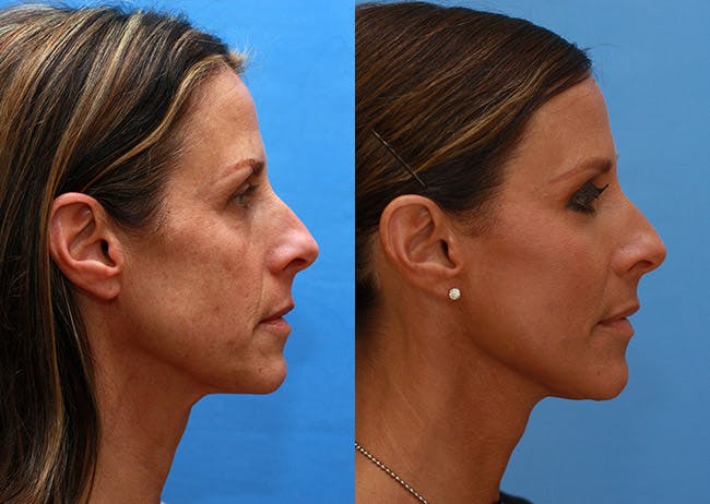 Neck Lift Before & After Gallery - Patient 319168 - Image 3