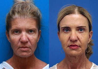 Brow Lift Before & After Gallery - Patient 385256 - Image 1