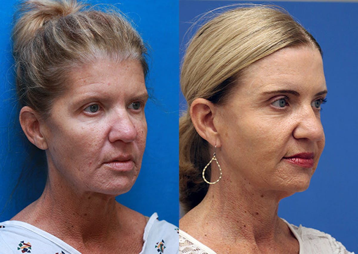 Face Before & After Gallery - Patient 391725 - Image 2