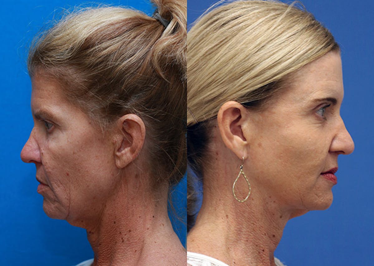 Face Before & After Gallery - Patient 391725 - Image 3
