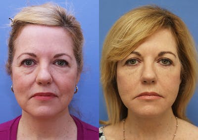 Neck Before & After Gallery - Patient 217968 - Image 1