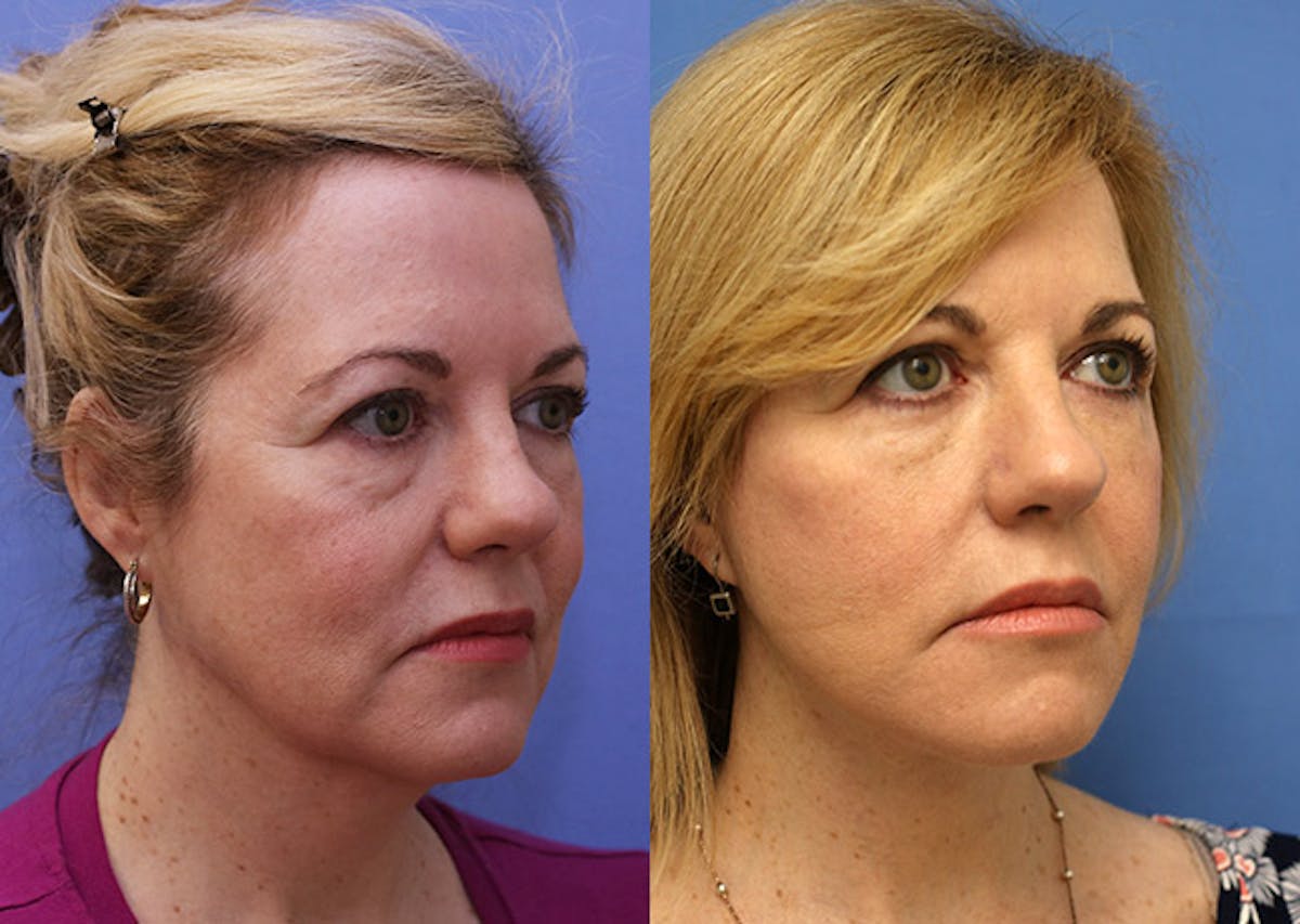 Face Before & After Gallery - Patient 164527 - Image 2