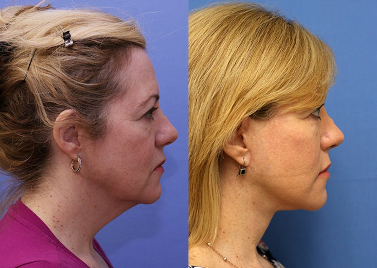 Face Before & After Gallery - Patient 164527 - Image 3