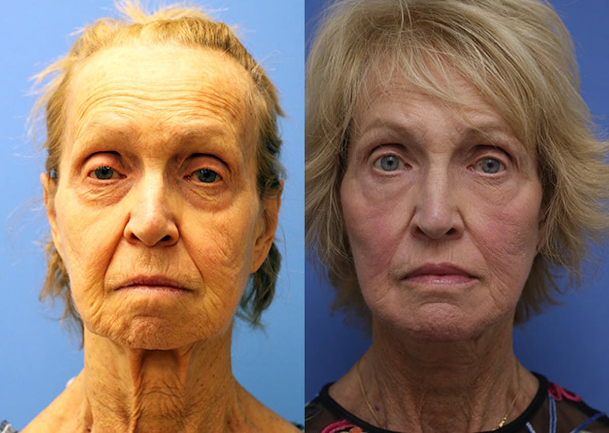 Face Before & After Gallery - Patient 202721 - Image 1