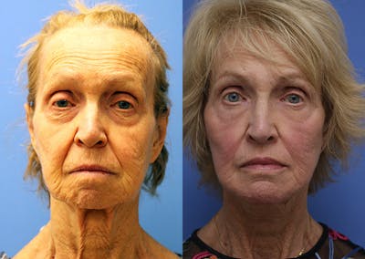 Face Before & After Gallery - Patient 202721 - Image 1