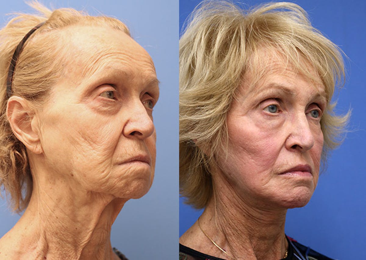 Face Before & After Gallery - Patient 202721 - Image 2