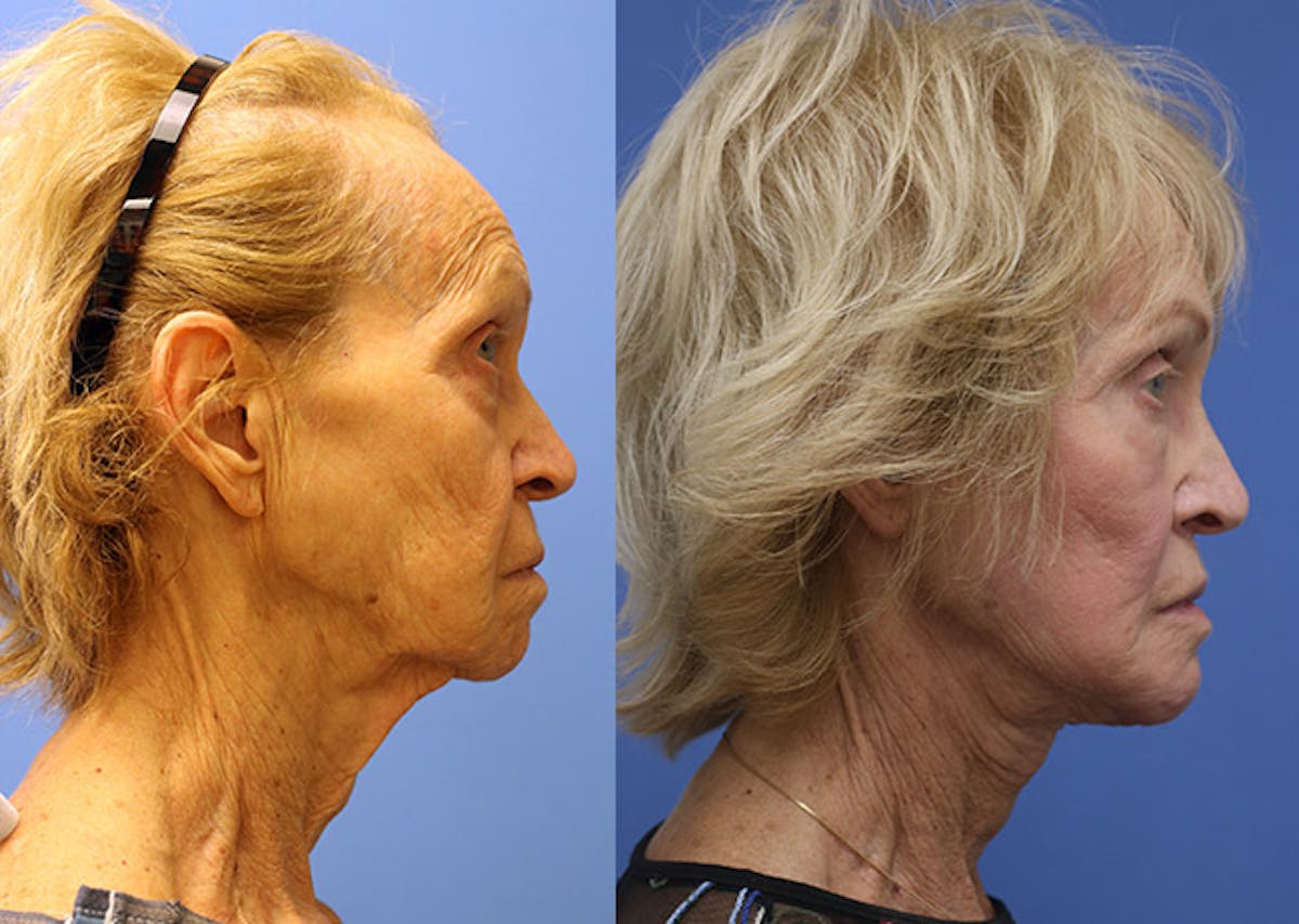 Face Before & After Gallery - Patient 202721 - Image 3