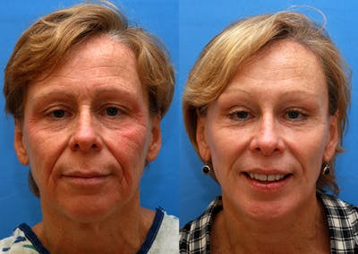 Brow Lift Before & After Gallery - Patient 135156 - Image 1