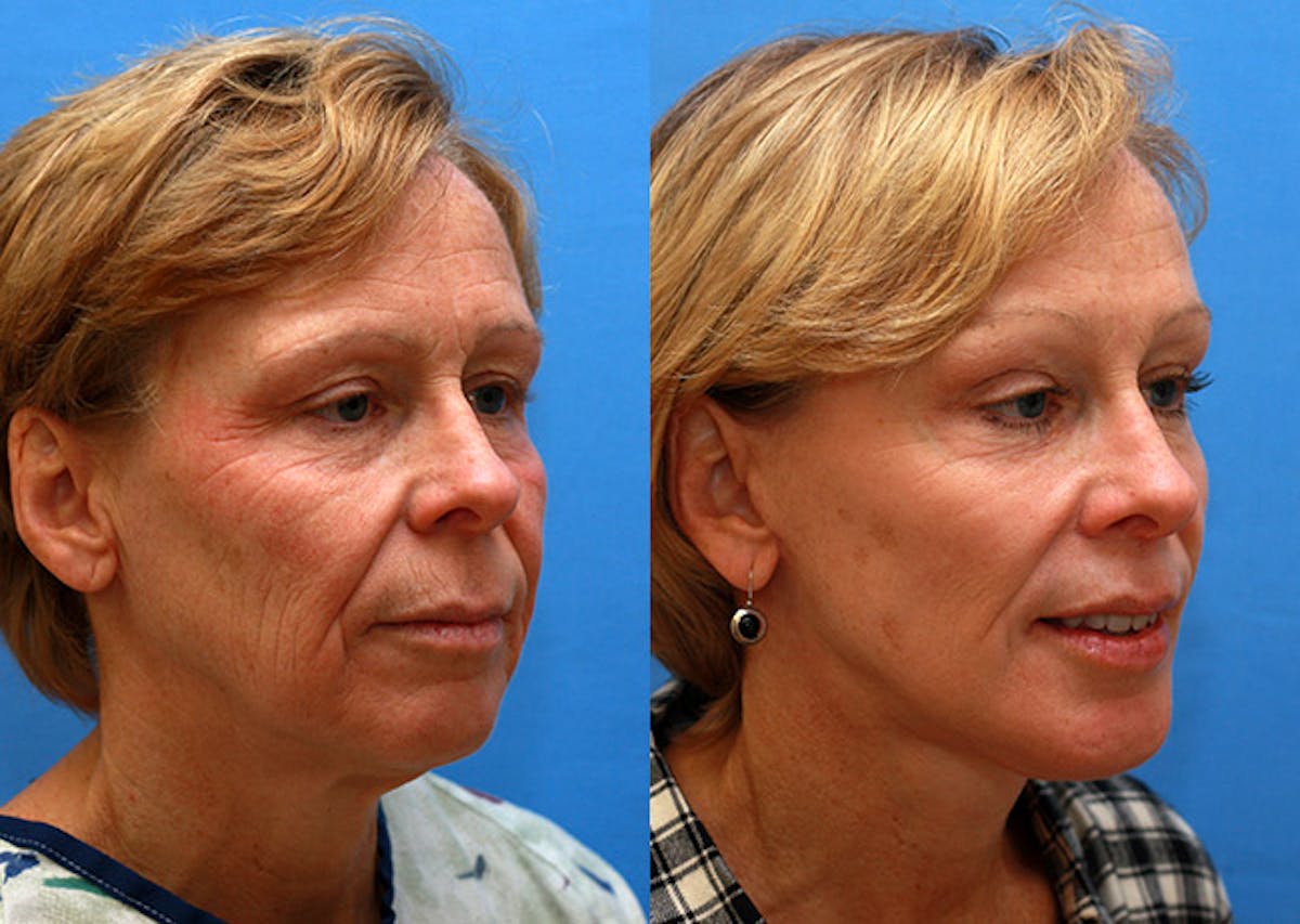 Face Before & After Gallery - Patient 283028 - Image 2