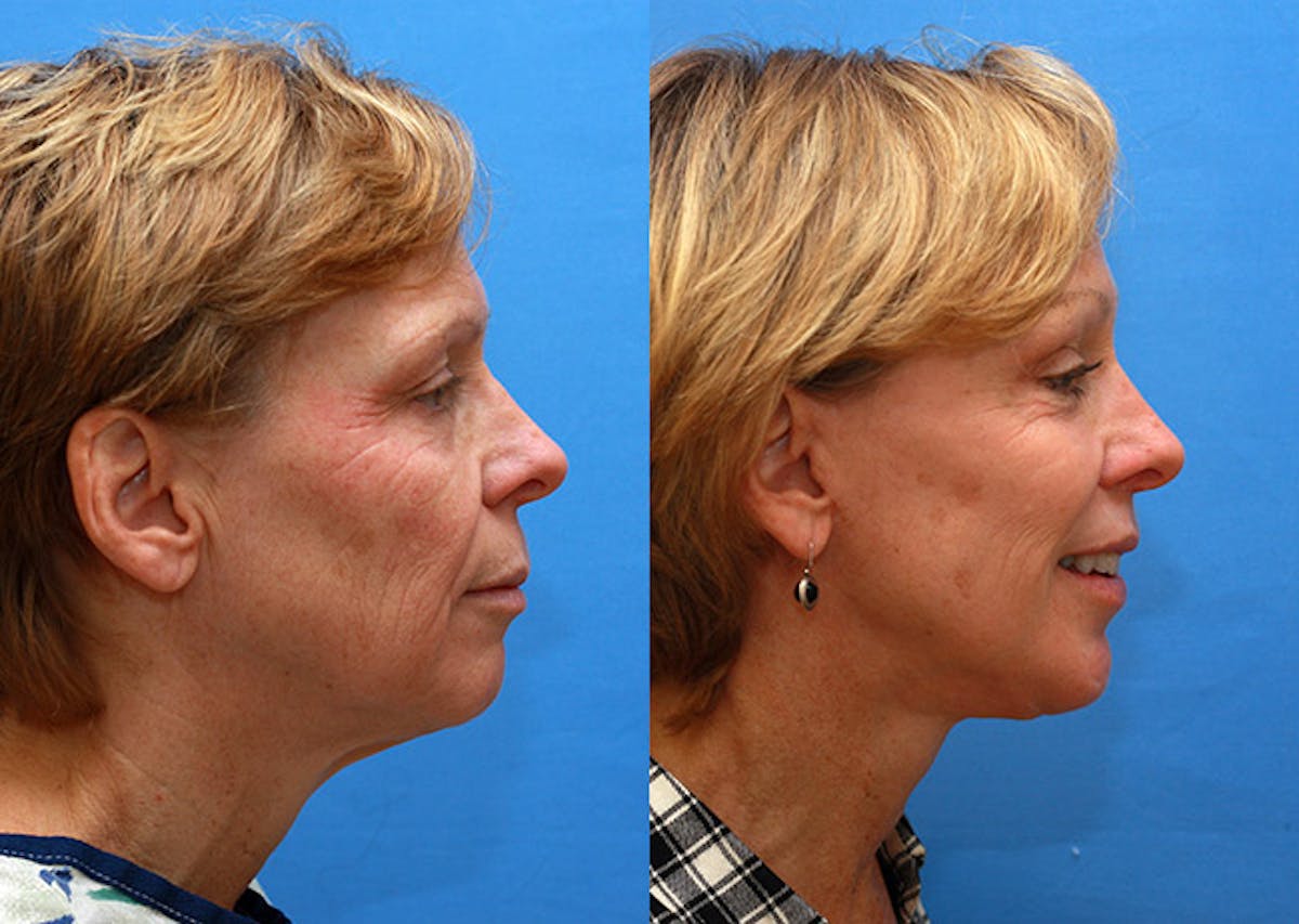 Facelift Before & After Gallery - Patient 125658 - Image 3