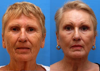 Brow Lift Before & After Gallery - Patient 245248 - Image 1