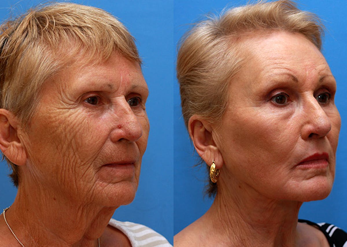 Neck Before & After Gallery - Patient 172979 - Image 2