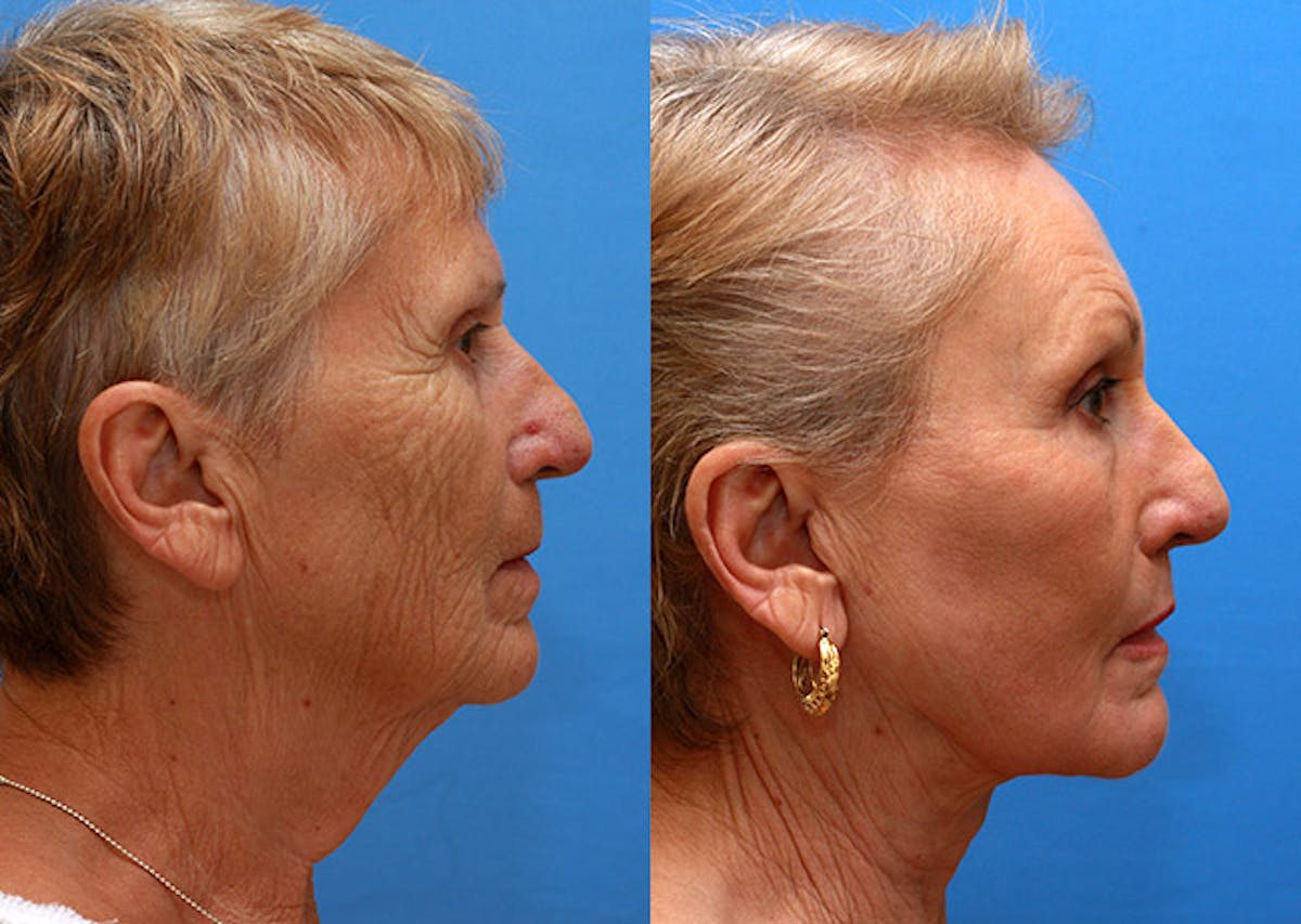 Neck Before & After Gallery - Patient 172979 - Image 3