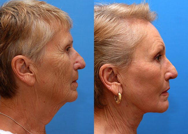 Neck Lift Before & After Gallery - Patient 255323 - Image 3