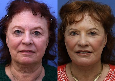 Neck Before & After Gallery - Patient 277924 - Image 1