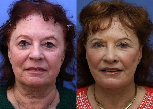 Neck Lift Before & After Gallery - Patient 326897 - Image 1