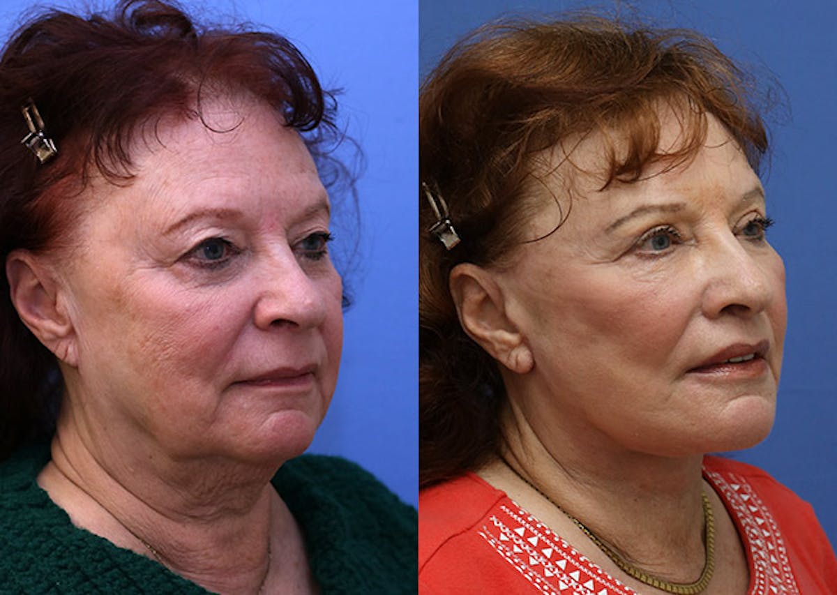 Face Before & After Gallery - Patient 411471 - Image 2
