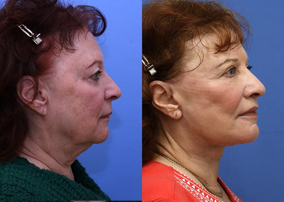 Face Before & After Gallery - Patient 411471 - Image 3