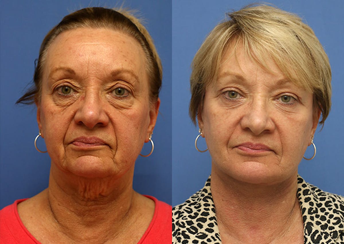 Neck Before & After Gallery - Patient 155481 - Image 1