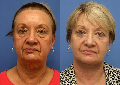 Neck Before & After Gallery - Patient 155481 - Image 1
