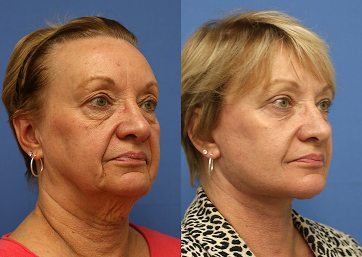 Neck Before & After Gallery - Patient 155481 - Image 2