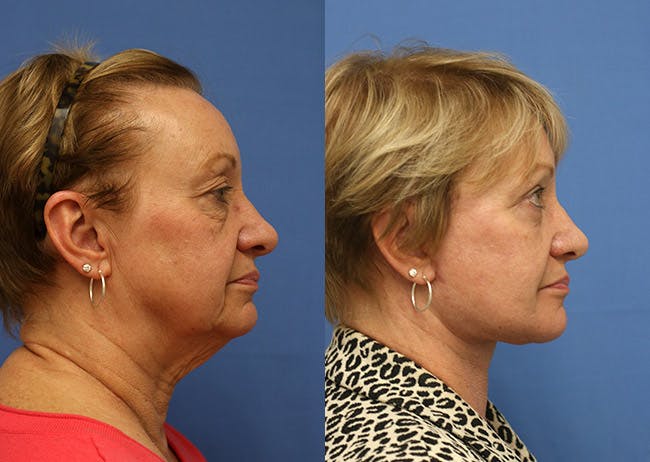 Neck Lift Before & After Gallery - Patient 346618 - Image 3
