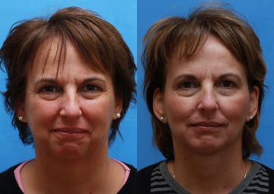 Face Before & After Gallery - Patient 378698 - Image 1