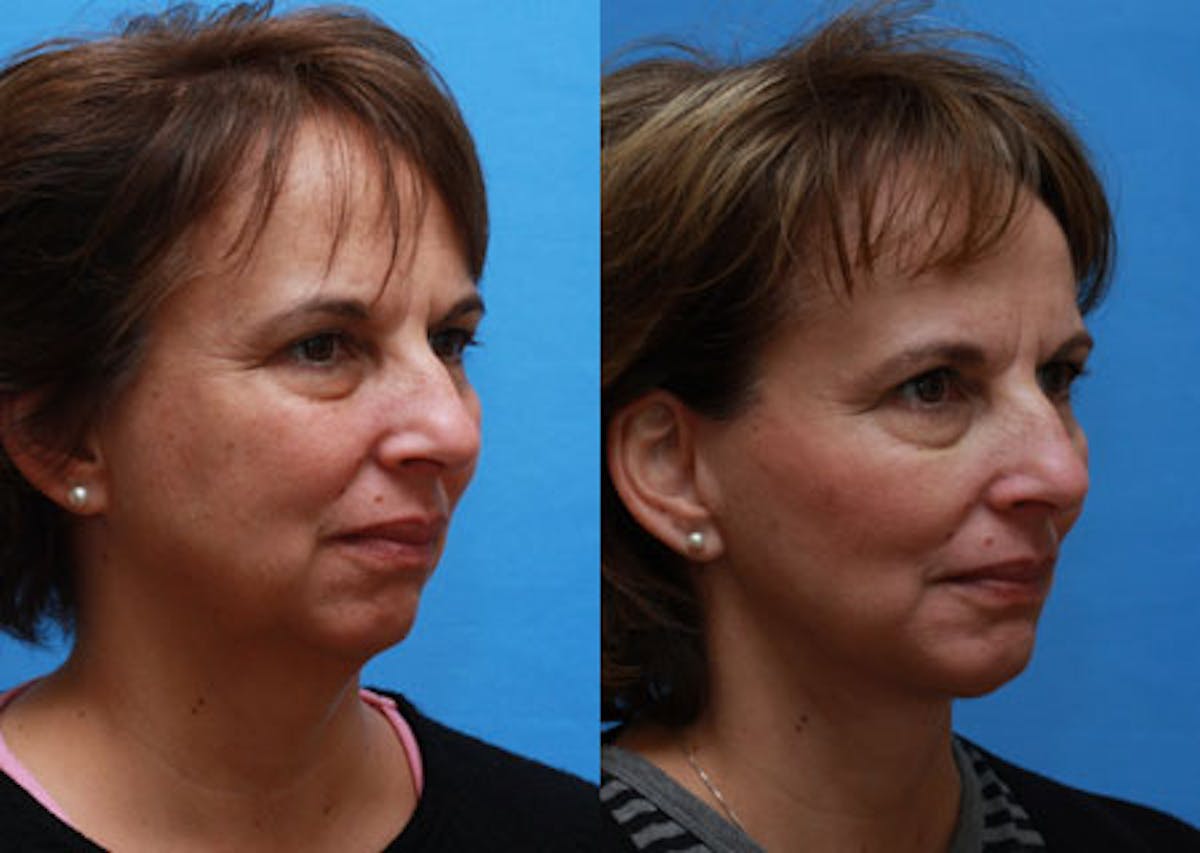 Face Before & After Gallery - Patient 378698 - Image 2