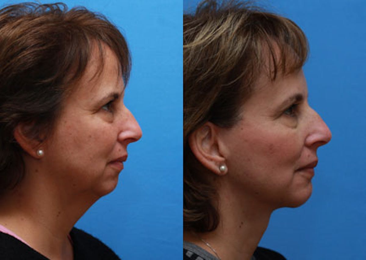 Face Before & After Gallery - Patient 378698 - Image 3
