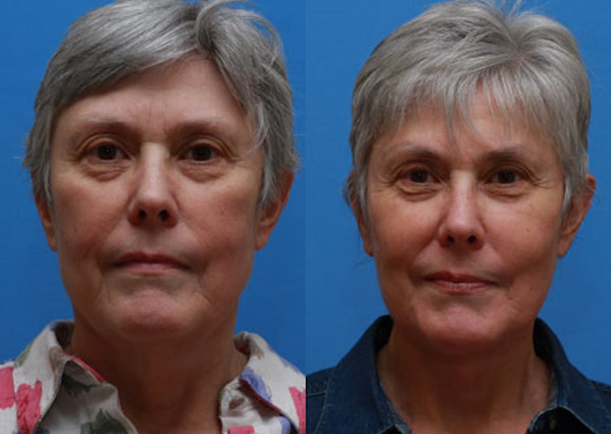 Facelift Before & After Gallery - Patient 172973 - Image 1