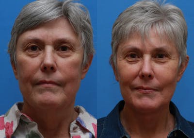 Face Before & After Gallery - Patient 346190 - Image 1