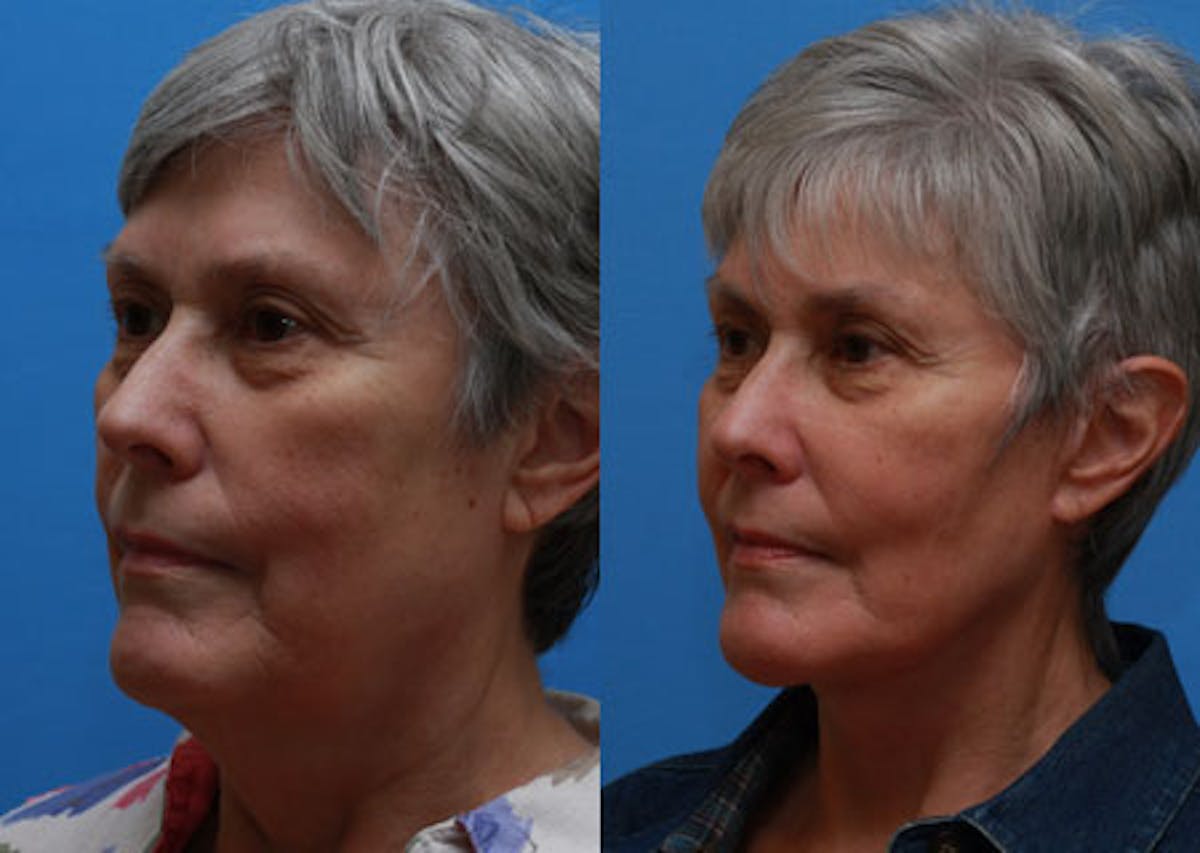 Facelift Before & After Gallery - Patient 172973 - Image 2