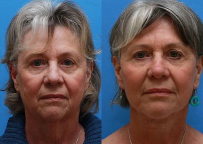 Face Before & After Gallery - Patient 228305 - Image 1
