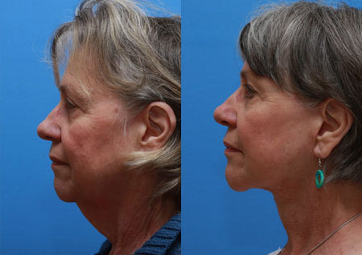 Face Before & After Gallery - Patient 228305 - Image 3