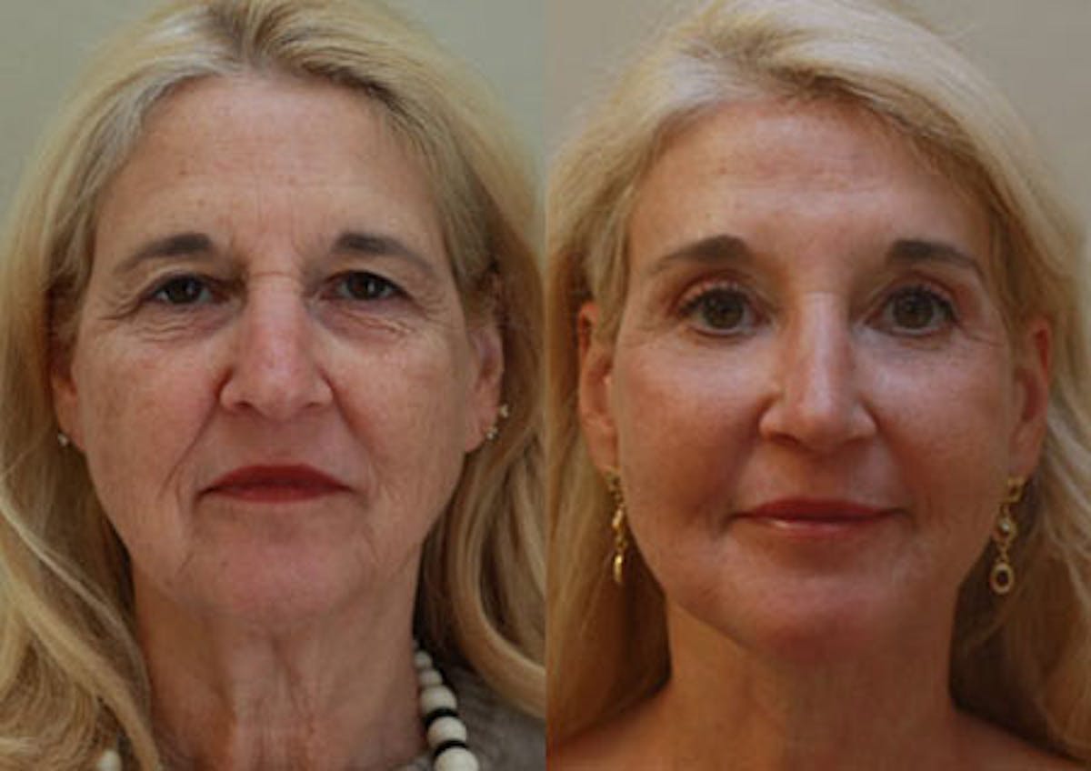 Face Before & After Gallery - Patient 252479 - Image 1