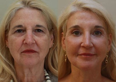 Face Before & After Gallery - Patient 252479 - Image 1