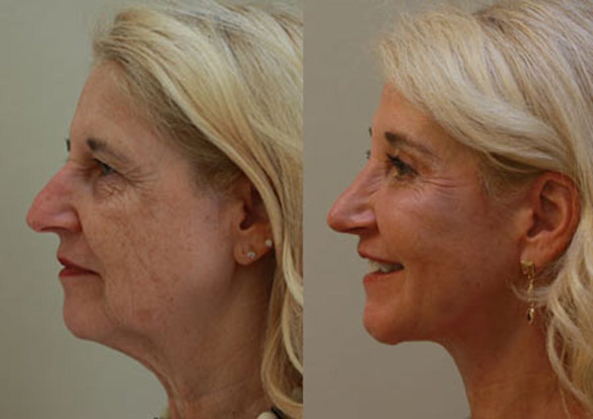 Face Before & After Gallery - Patient 252479 - Image 2