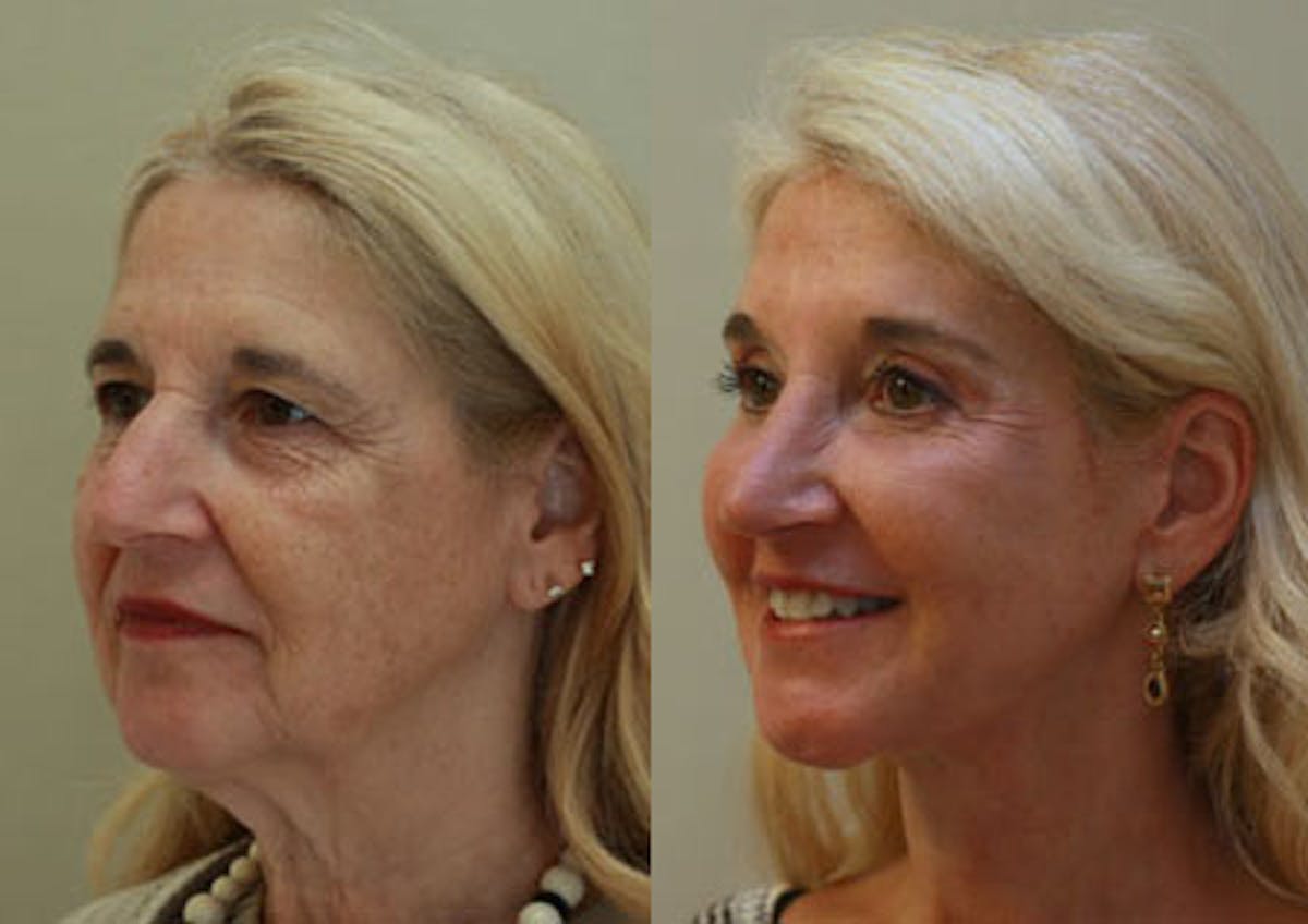 Face Before & After Gallery - Patient 252479 - Image 3