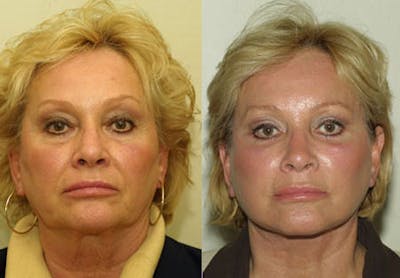 Face Before & After Gallery - Patient 382490 - Image 1