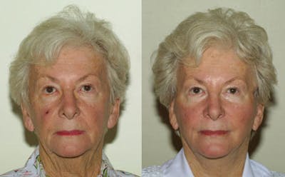 Face Before & After Gallery - Patient 231451 - Image 1
