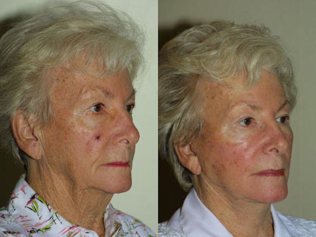Face Before & After Gallery - Patient 231451 - Image 2