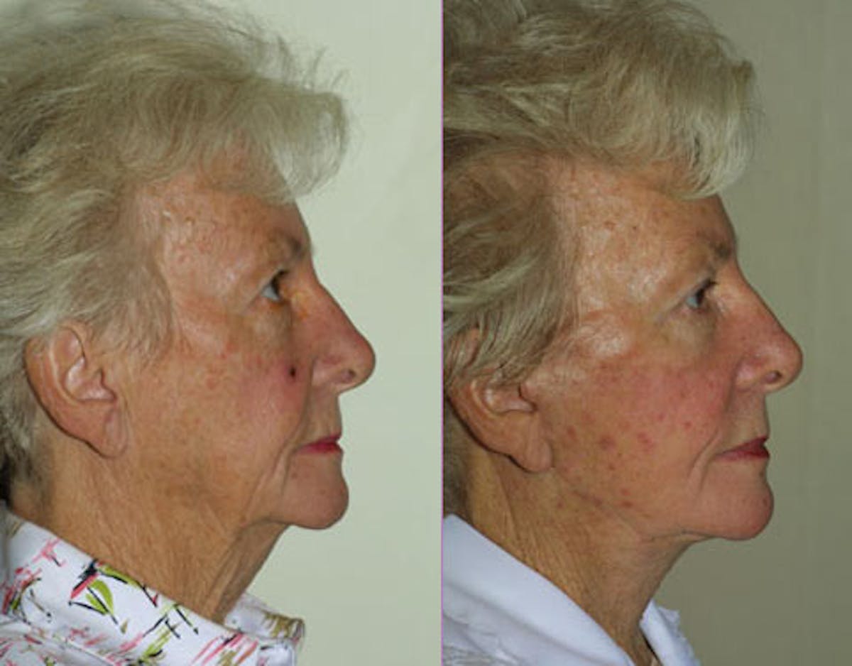 Face Before & After Gallery - Patient 231451 - Image 3