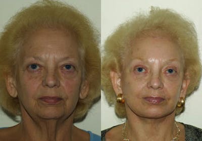 Face Before & After Gallery - Patient 245643 - Image 1